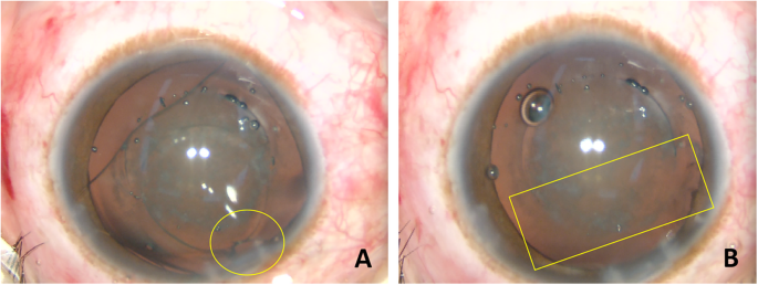 Cataract